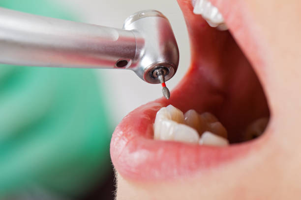 Best Emergency Wisdom Tooth Extraction in Dewey, OK